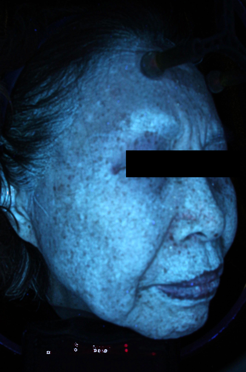 70대 여성 기미, 검버섯, 비립종, 광각화증제거